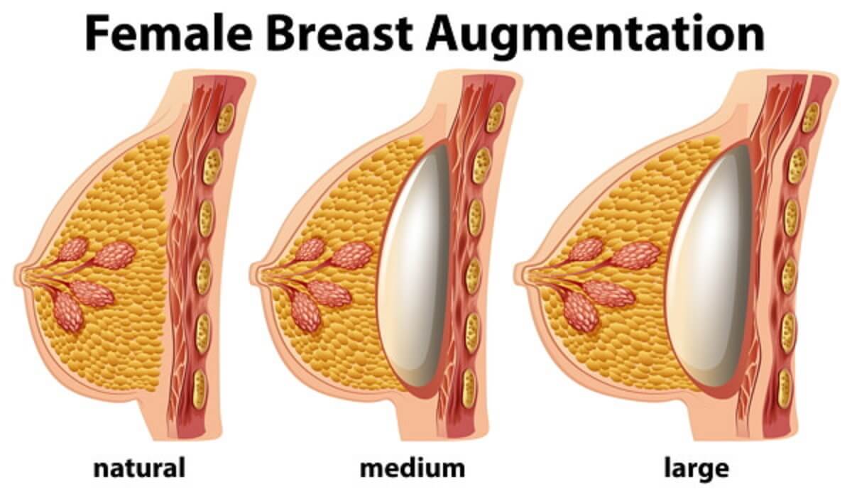 Understanding the Different Types of Breast Augmentation