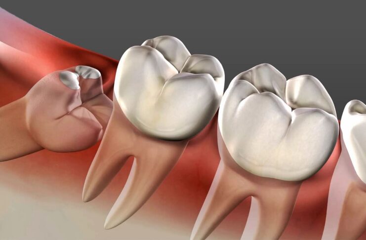 Why Your Wisdom Teeth Are Giving You Constant Pain and What to Do About It